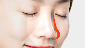 ฉีดสารเสริมจมูก แทนการผ่าตัด