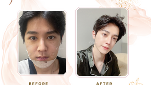 รีวิวศัลยกรรมโครงหน้าผู้ชาย