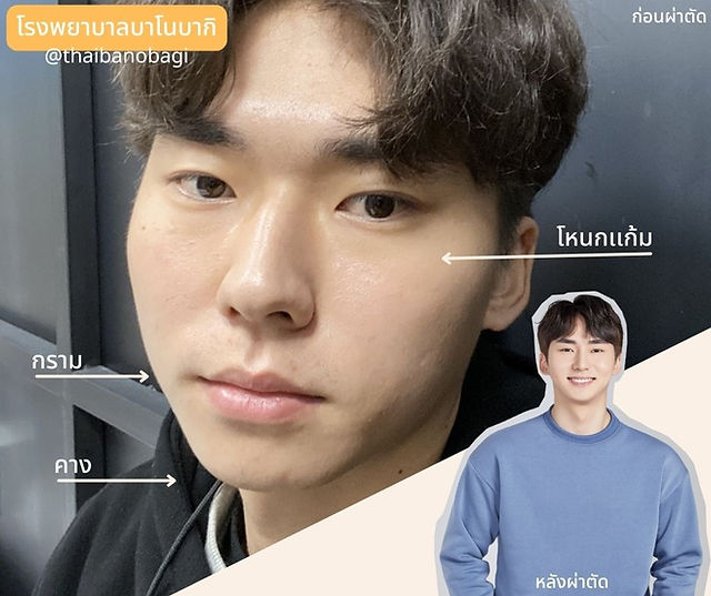 รีวิวศัลยกรรมผู้ชาย > โรงพยาบาลบาโนบากิ (Banobagi Plastic Surgery)