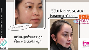 รีวิวเสริมจมูกด้วยกระดูกซี่โครงและลดปีกจมูก โรงพยาบาลบาโนบากิ