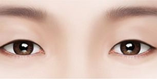 ศัลกรรมผ่าตัดแก้ไขตาสองชั้นที่ ID Hospital