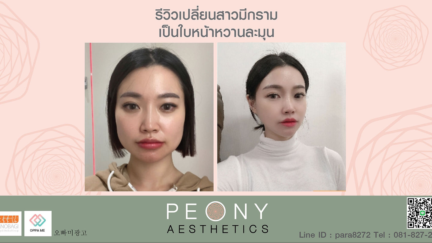 รีวิวศัลกรรมโครงหน้า เปลี่ยนจากสาวมีกราม เป็นใบหน้าหวานละมุน (ตอนที่ 2)