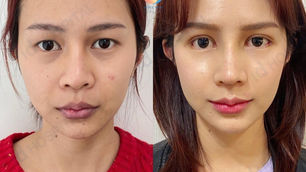 😘 อัพเดทลูกสาวว #หลังผ่าตัดจมูกตา ครบ 14 วันหน่อยค่าา บวมน้อยสุดดด