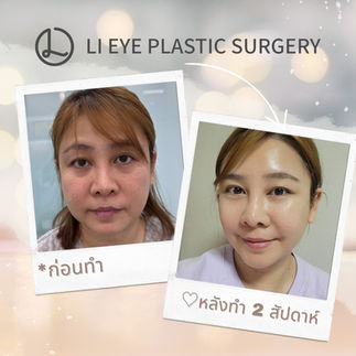รีวิวศัลยกรรมเกาหลี โรงพยาบาลศัลยกรรมลีอาย (Li eye Plastic Surgery)
