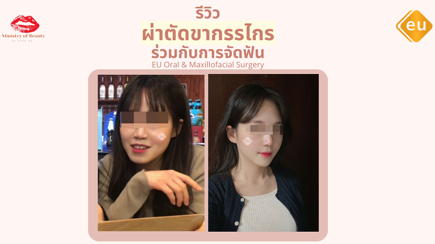 รีวิวการผ่าตัดขากรรไกรร่วมกับการจัดฟัน (ตอนที่ 1)