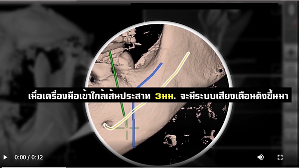 ศัลยกรรมขากรรไกรด้วยเทคนิคเนวิเกชั่นเฉพาะที่โรงพยาบาลไอดี