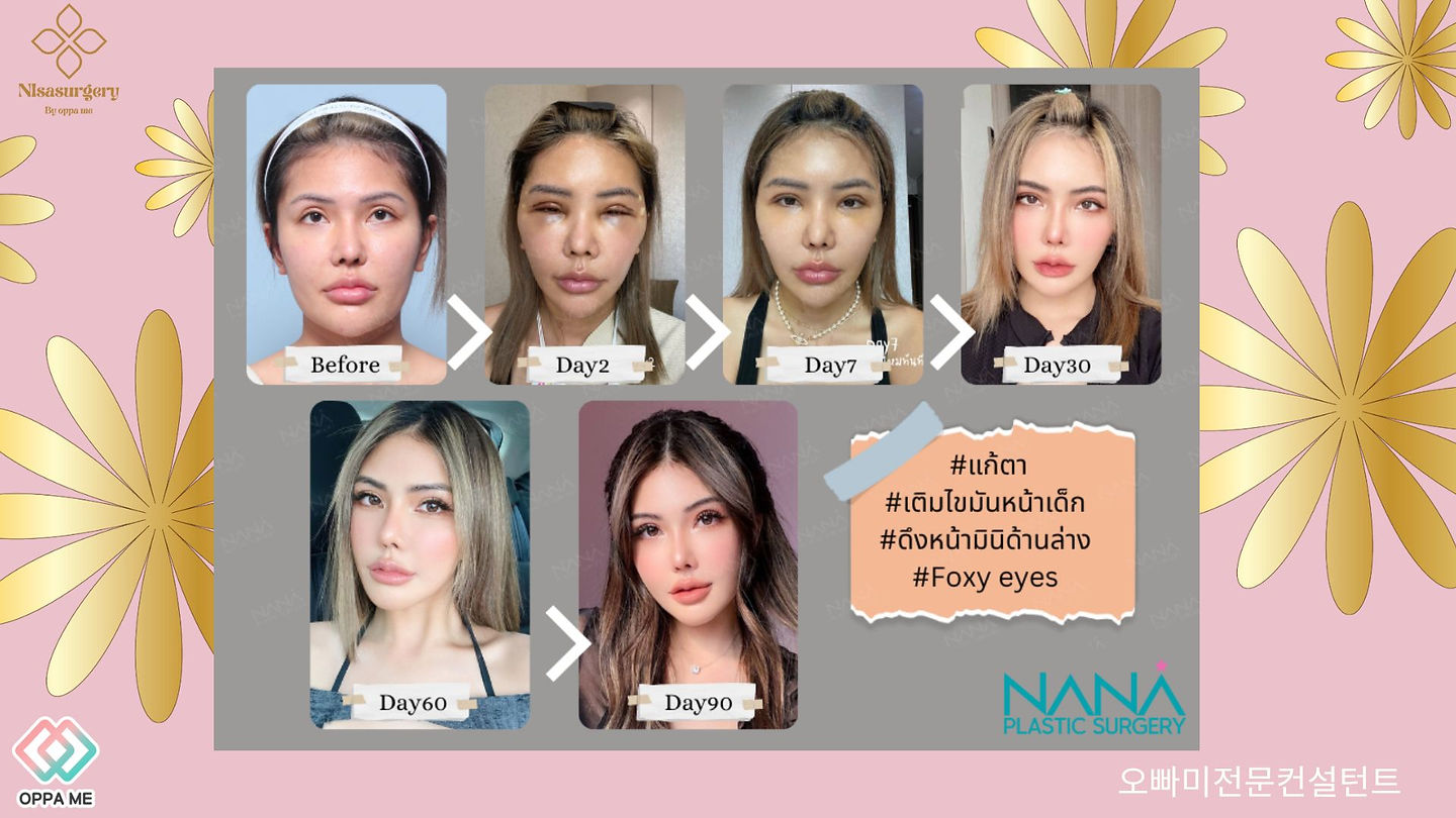 รีวิวฉีดไขมันหน้าเด็ก+แก้ไขตา ทำFoxy eyes+ดึงมินิลิฟติ้ง กรอบหน้าเรียว วีไลน์ (ตอนที่ 1)