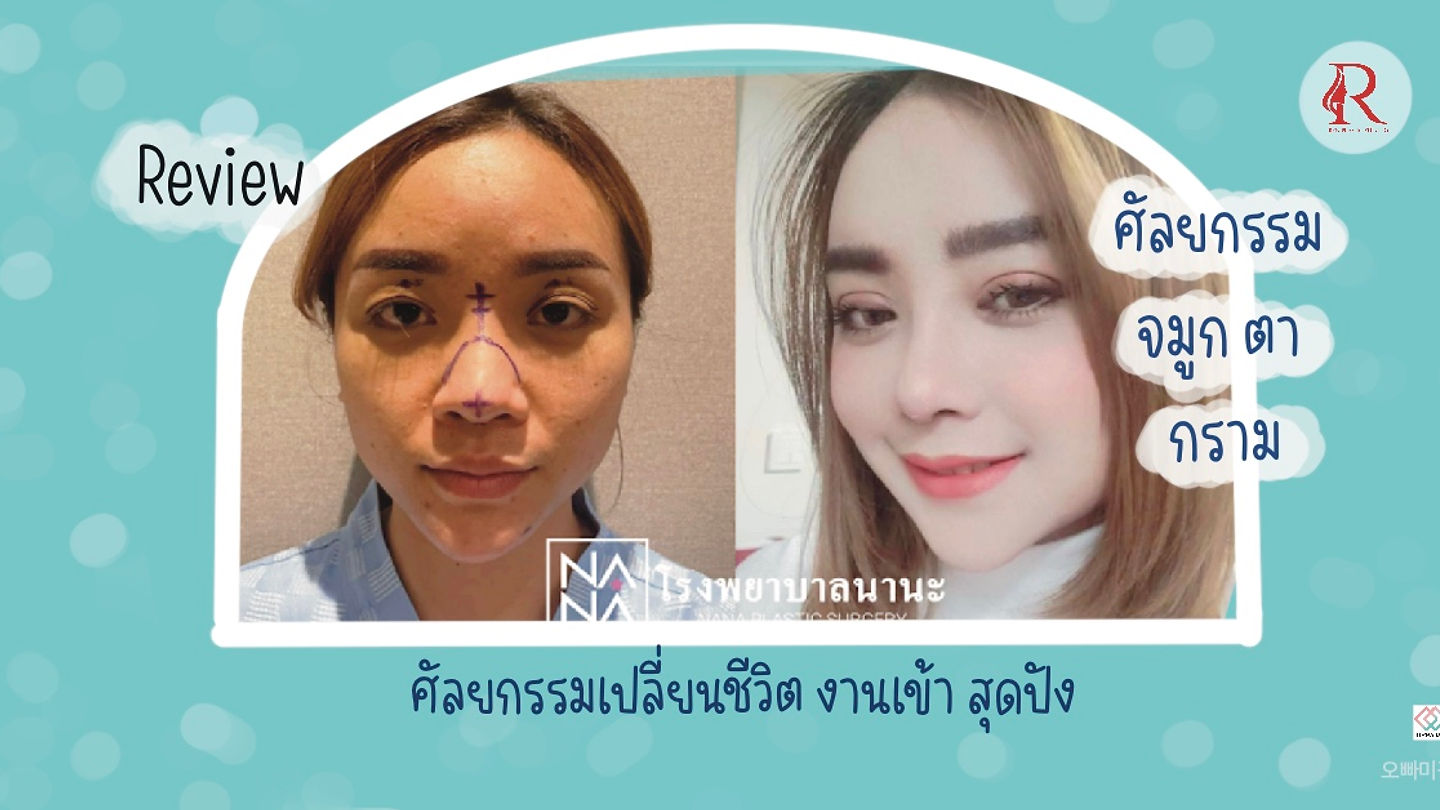 รีวิว “ศัลยกรรม ตา จมูก กราม ที่NANA” (ตอนที่ 2)