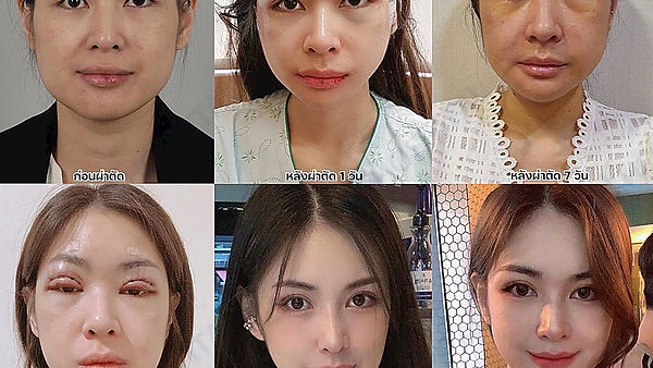 รีวิว โครงหน้ากับตา 2 ชั้น เหมือนเกิดใหม่ที่ ID (ตอนที่ 1)