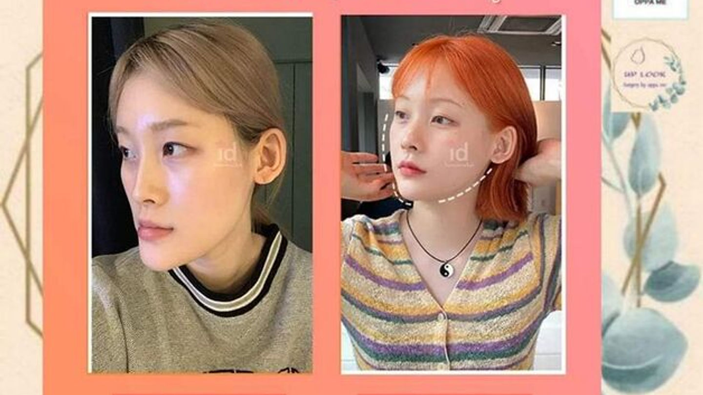 เคสรีวิวจริง ผ่าตัดขากรรไกร พร้อมโครงหน้า3จุด สุดจึ๋งงง🥳🥳 (ตอนที่ 2)