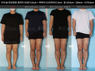 รีวิวผ่าตัดเพิ่มส่วนสูง