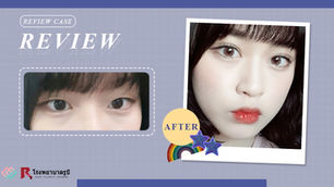 รีวิวกรีดตาสองชั้น เปิดหัว+หางตา ปรับกล้ามเนื้อตา