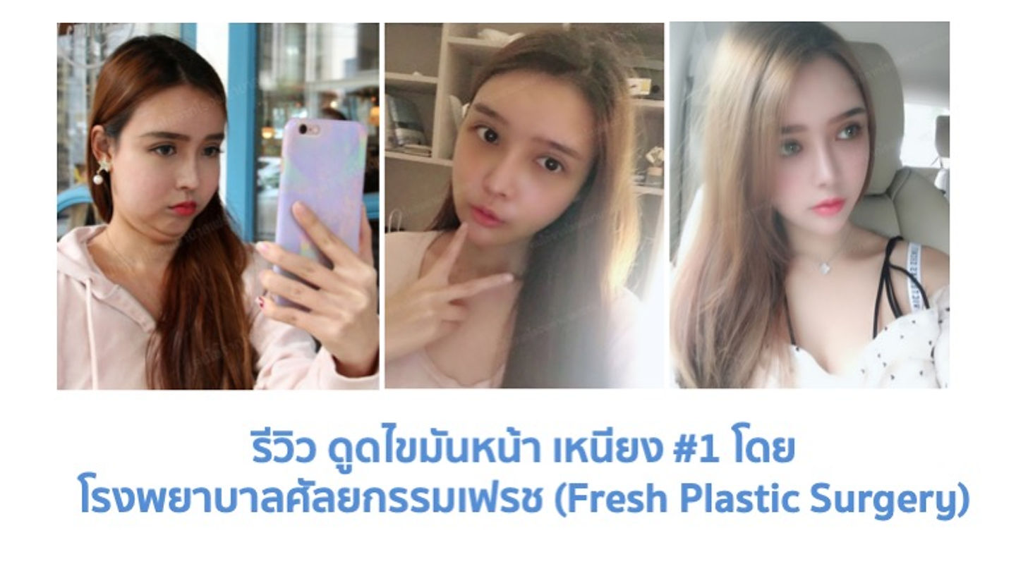 รีวิว ดูดไขมันหน้า เหนียง #1 โดย โรงพยาบาลศัลยกรรมเฟรช (Fresh Plastic Surgery) (ตอนที่ 1)
