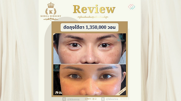 รีวิว ตัดถุงใต้ตา แผลสวย แถม หน้าเด็ก