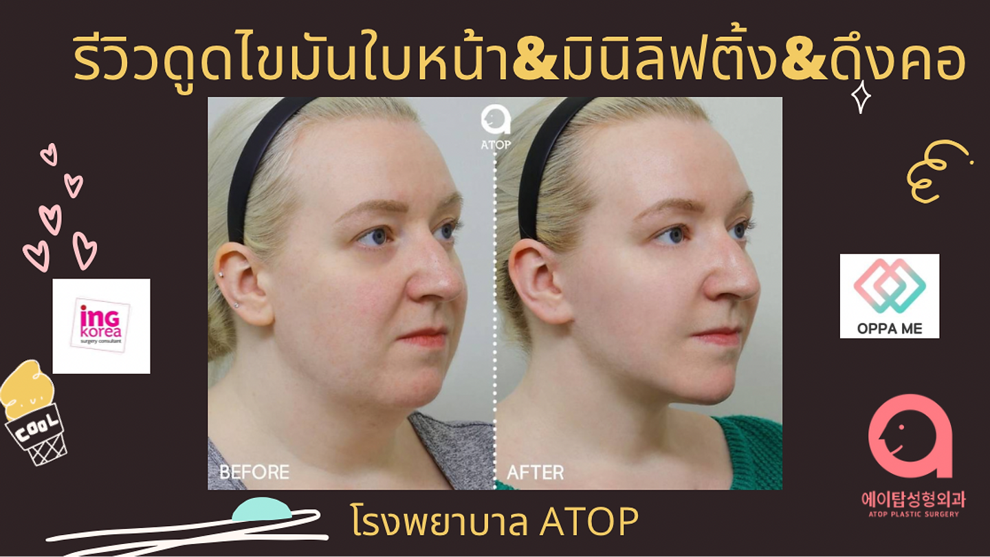 รีวิวดูดไขมันหน้า ดึงคอ ยกกระชับมินิลิฟติ้ง โรงพยาบาล ATOP (ตอนที่ 2)