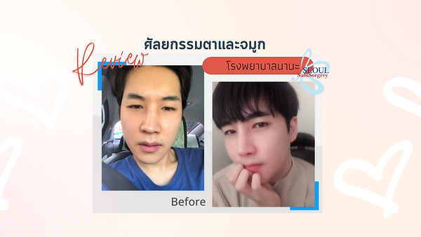 ศัลยกรรมตาและเสริมจมูกผู้ชายโรงพยาบาลนานะ (ตอนที่ 1)