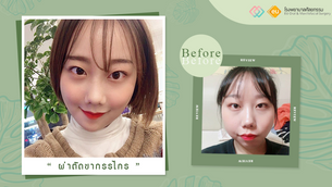 รีวิวผ่าตัดขากรรไกร แก้ไขใบหน้าผิดรูป
