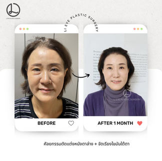 รีวิวศัลยกรรมเกาหลี โรงพยาบาลศัลยกรรมลีอาย (Li eye Plastic Surgery)