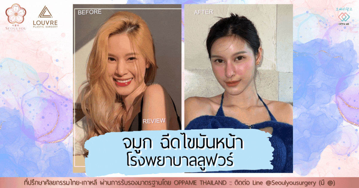 รีวิวศัลยกรรมจมูก และฉีดไขมันหน้า โรงพยาบาลลูฟวร์ – LOURVE Plastic Surgery (ตอนที่ 1)