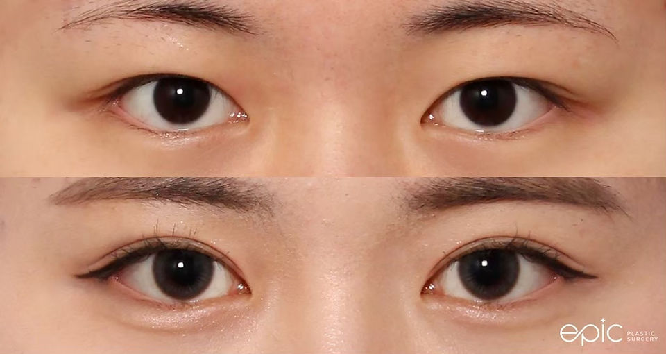 รีวิวศัลยกรรมตา รพ.อีพิก Epic หมอโน ยองจุน