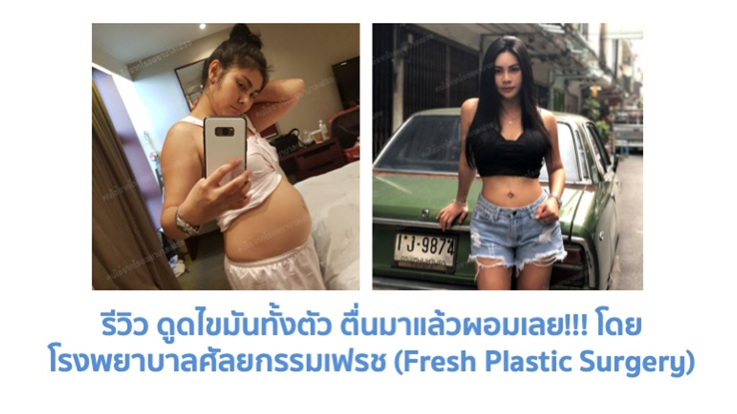 รีวิว ดูดไขมันทั้งตัว ตื่นมาแล้วผอมเลย!!! โดย โรงพยาบาลศัลยกรรมเฟรช (Fresh Plastic Surgery) (ตอนที่ 1)