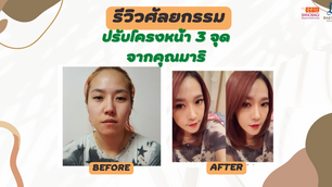 รีวิวศัลยกรรมปรับโครงหน้า 3 จุดจากคุณมาริ