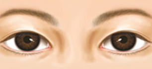 ภาวะตาตก และวิธีผ่าตัด