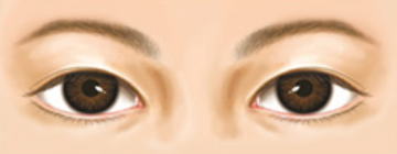 ภาวะตาตก และวิธีผ่าตัด