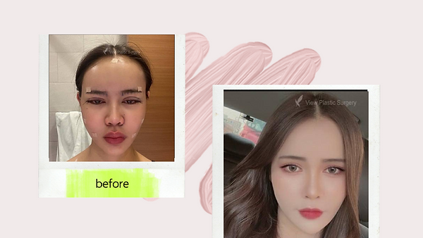 รีวิวศัลยกรรมฉีดไขมันใบหน้า+ตาสองชั้น (ตอนที่ 1)