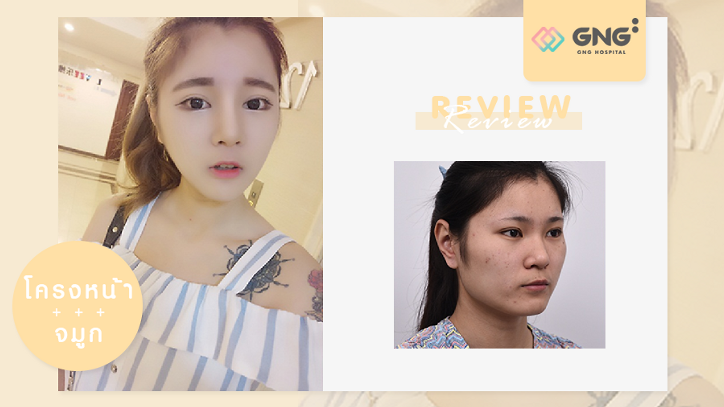 รีวิวปรับโครงหน้า และเสริมจมูก แก้ปัญหาจมูกใหญ่ (ตอนที่ 1)