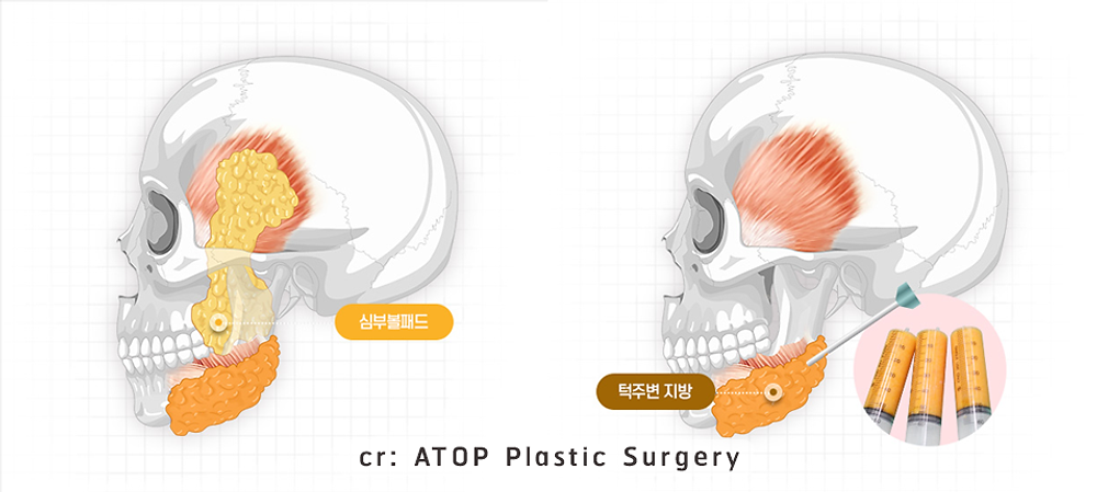 หน้าเรียวด้วย Facial Shaping Surgery ไม่ต้องตัดกระดูก