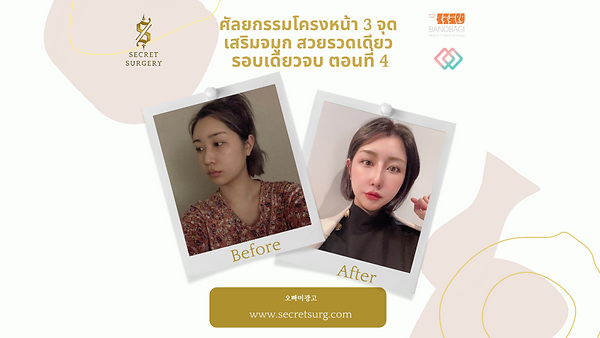 ศัลยกรรมโครงหน้า3จุด เสริมจมูก สวยรวดเดียว รอบเดียวจบ ตอนที่ 4