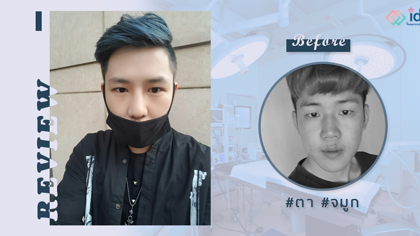 รีวิวเย็บตาสองชั้น และเสริมจมูกบาร์บี้ไลน์ ของลีแทอู (ตอนที่ 2)