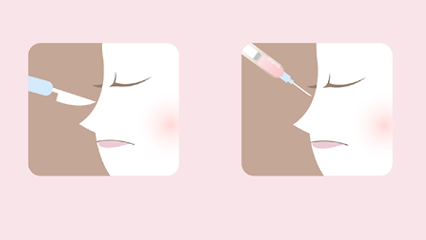 ประเภทของศัลยกรรมจมูก แบ่งออกเป็นกี่ประเภท (ตอนที่ 1)