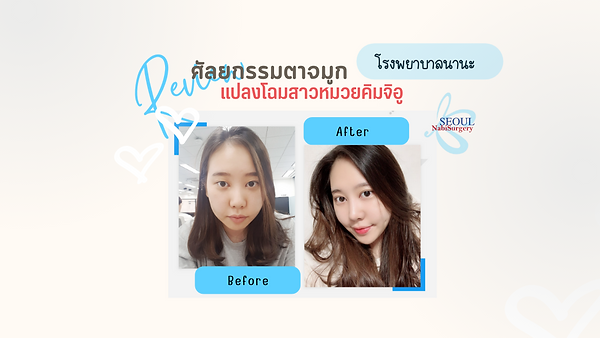 รีวิวศัลยกรรมตาจมูก แปลงโฉมสาวหมวยคิมจิอู โรงพยาบาลนานะ (ตอนที่ 1)