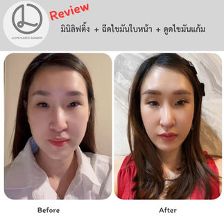 รีวิวศัลยกรรมเกาหลี โรงพยาบาลศัลยกรรมลีอาย (Li eye Plastic Surgery)