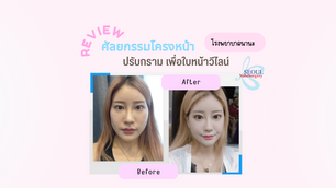 รีวิวศัลยกรรมโครงหน้า ปรับกราม เพื่อใบหน้าวีไลน์