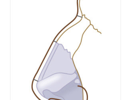 จมูกเหยี่ยว และ วิธีผ่าตัดแก้ไข