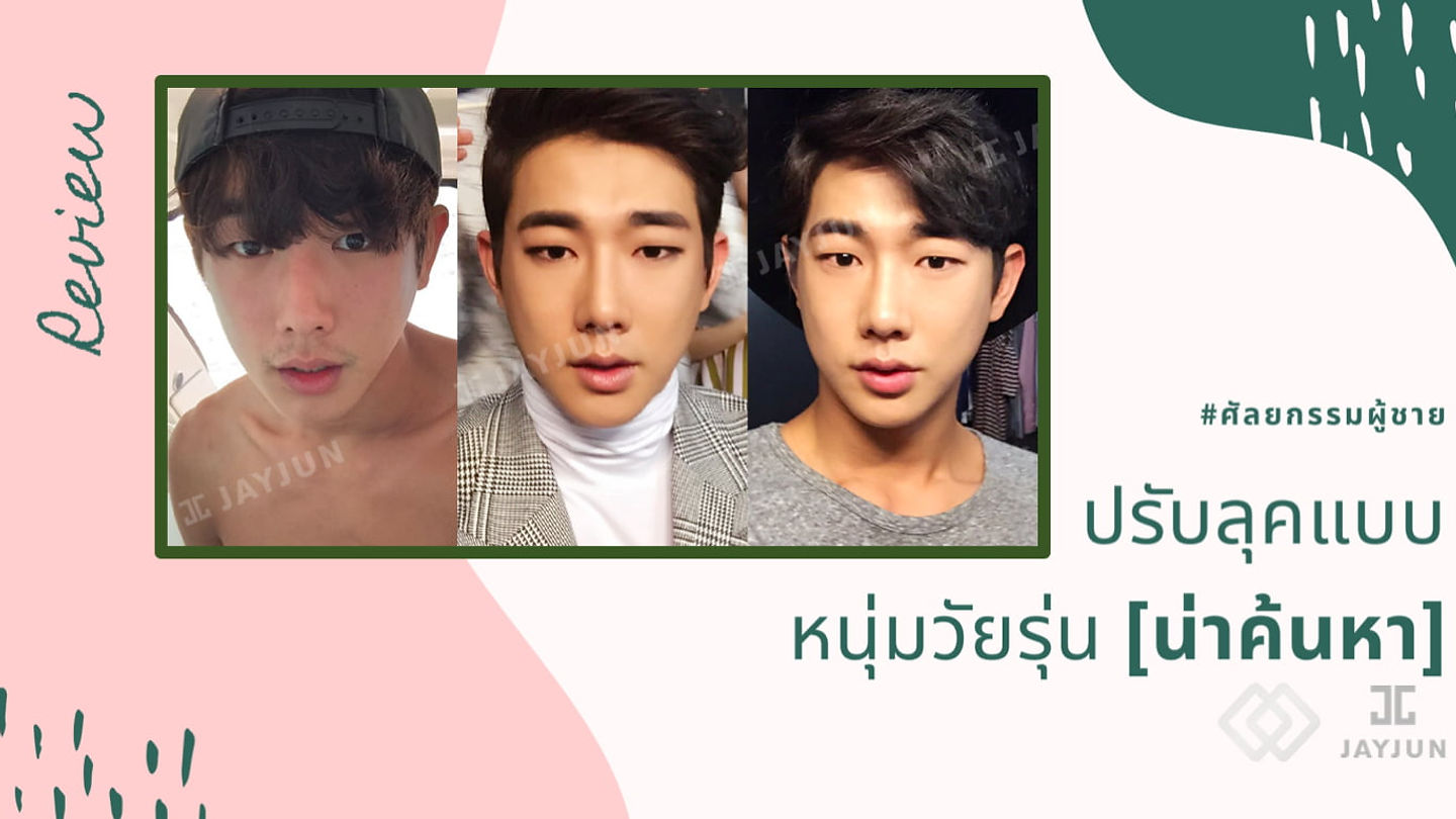 รีวิวศัลยกรรมผู้ชาย: ปรับลุคเป็นเด็กหนุ่ม น่าค้นหา (ปรับรูปหน้า+เสริมจมูก) (ตอนที่ 1)