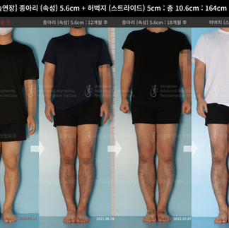 รีวิวผ่าตัดเพิ่มความสูง