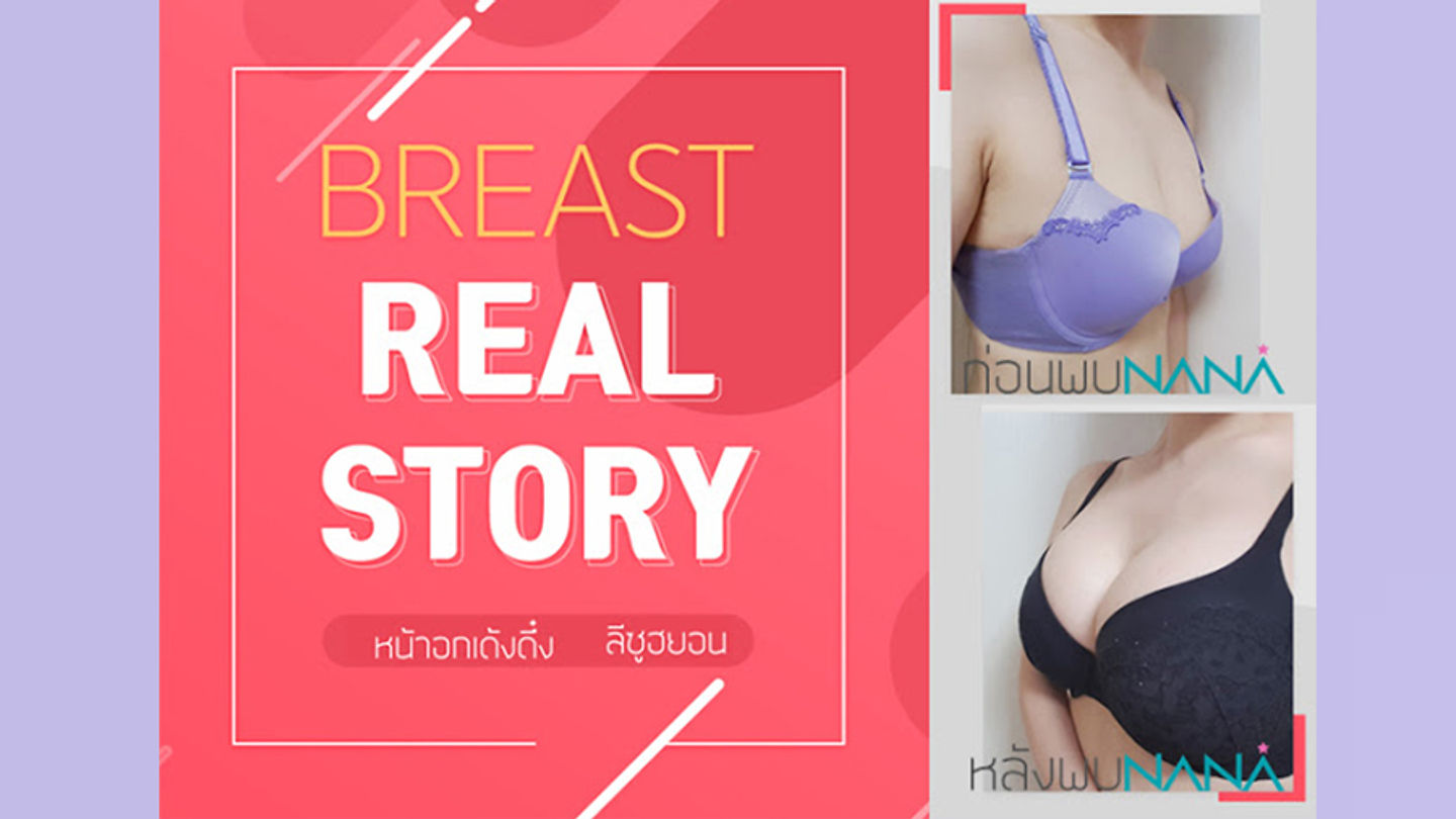 [ศัลยกรรมหน้าอก] รีวิวศัลยกรรม Real Story – อกสวยเด้งดึ๋ง วอลลุ่มอัพ ต้องนานะ (ตอนที่ 1)