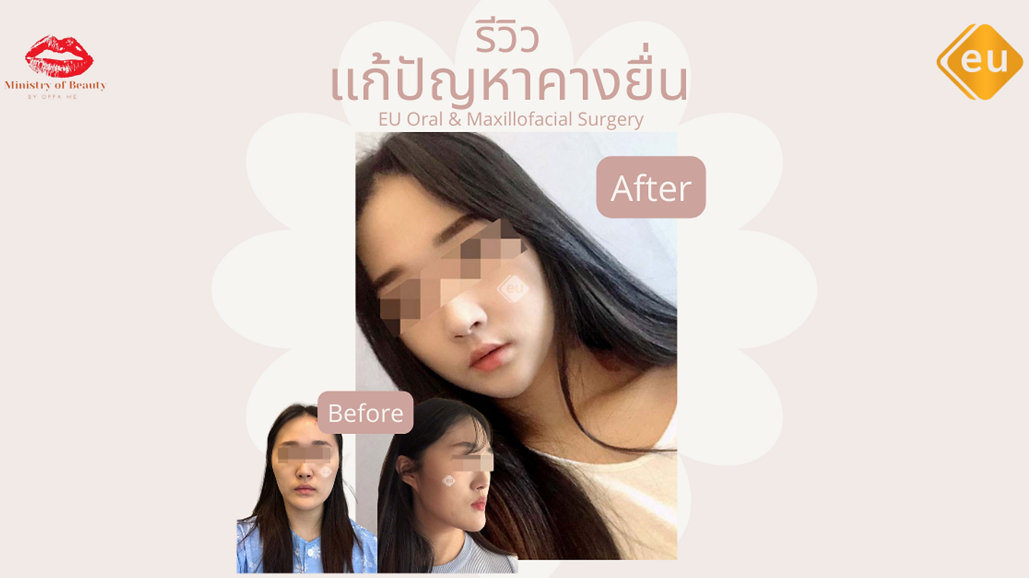 รีวิวแก้ปัญหาคางยื่น พร้อมปรับโครงหน้าที่ EU (ตอนที่ 2)