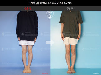 รีวิวผ่าตัดเพิ่มส่วนสูง