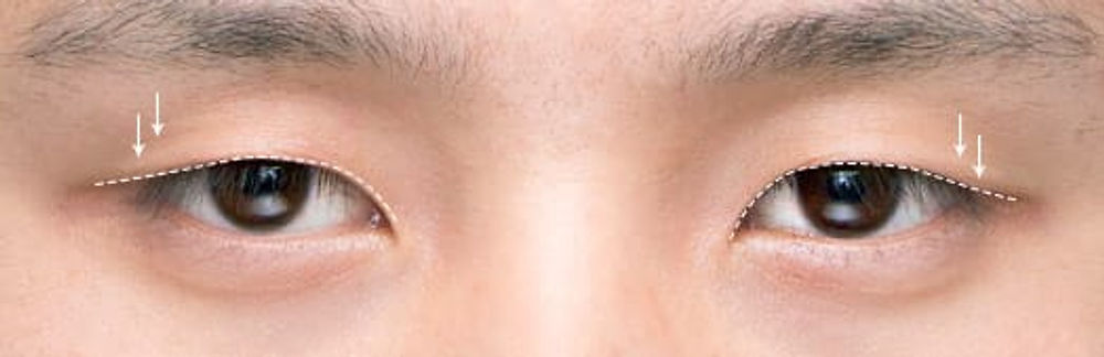 Incision double eyelid surgery line