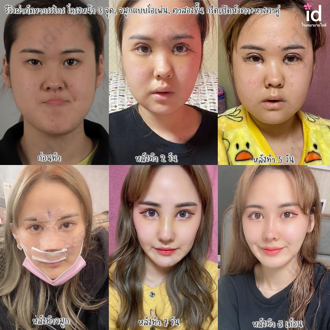 รีวิวศัลยกรรมเกาหลี