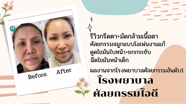 หน้าเด็กลง 10 ปี ไม่ใช่ฝันอีกต่อไป รีวิวจากเคสจริง กรีดตาสองชั้น+มัดกล้ามเนื้อตา, ศัลยกรรมจมูกโอเพ่น (ตอนที่ 1)
