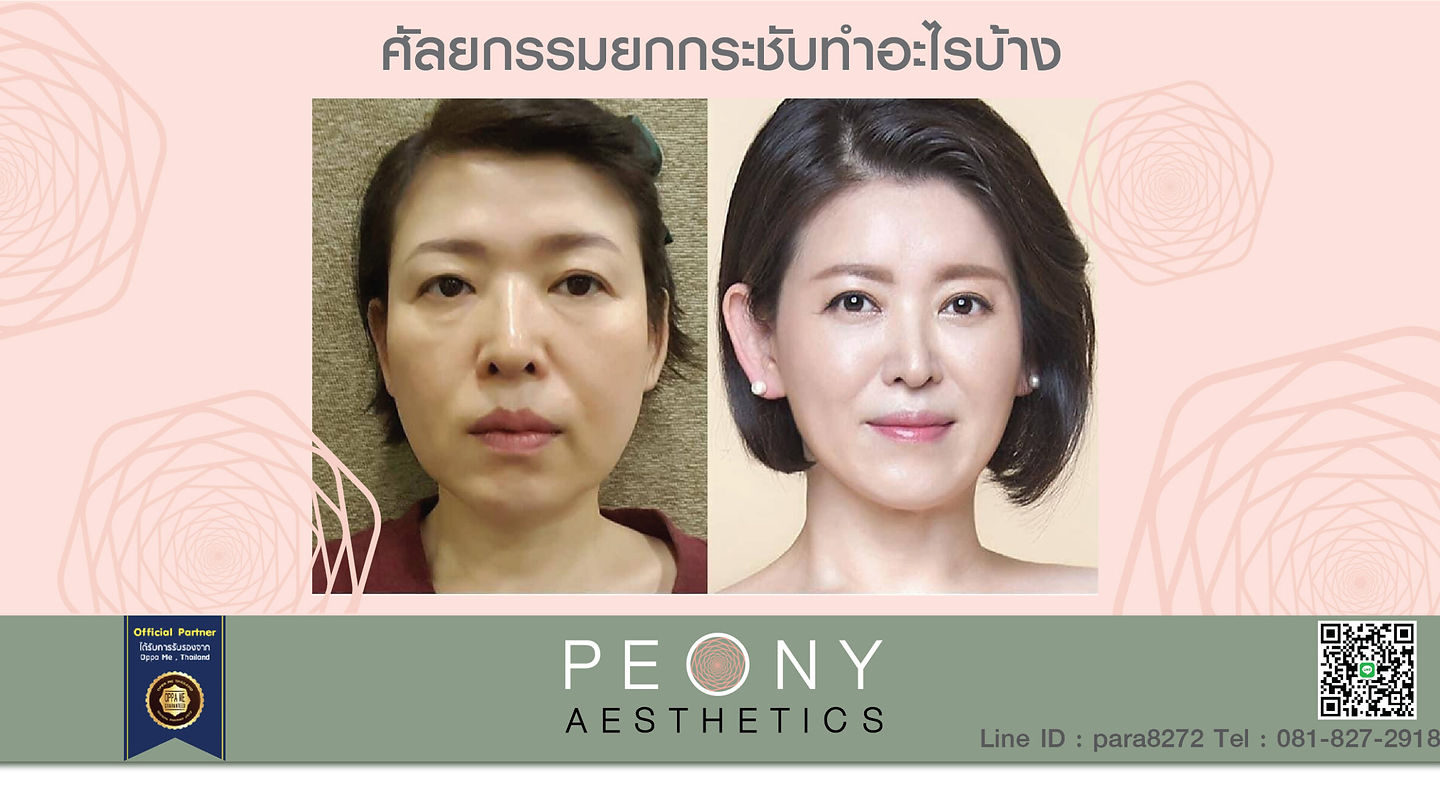 ศัลยกรรมยกกระชับ ชะลอวัย โรงพยาบาลศัยกรรม JW (ตอนที่ 1)