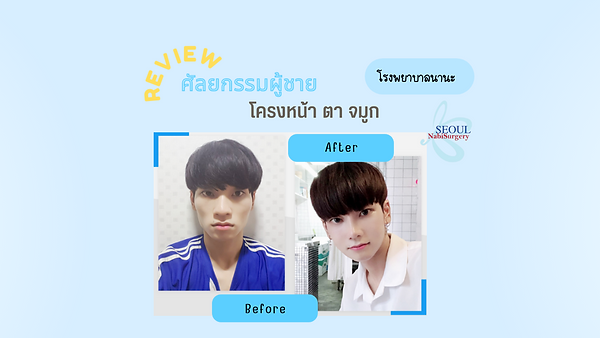 รีวิวศัลยกรรมโครงหน้า จมูกและตาผู้ชาย (ตอนที่ 1)