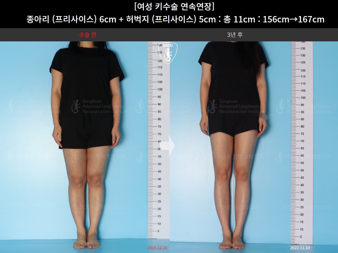 รีวิวผ่าตัดเพิ่มส่วนสูง ที่เกาหลี