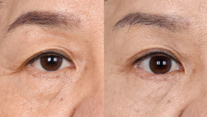 ยกกระชับคิ้ว แก้ปัญหาตาตก